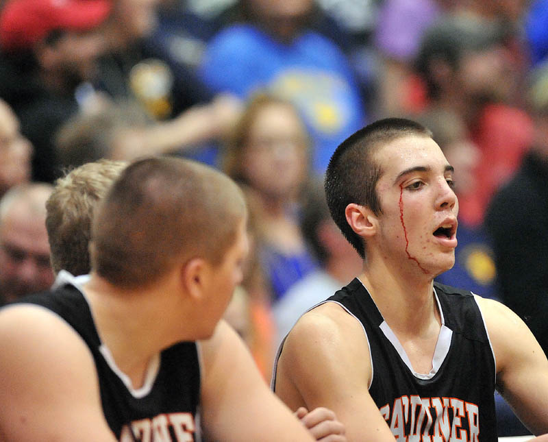 Photo by Michael G. Seamans Gardiner High School's Aaron Toman, 33, bleeeds from the left eye as he sits on the bench in the first half of the Eastern Class B semi-finals at the Bangor Auditorium Wednesday. Gardiner defeated Medomak Valley 57-46.