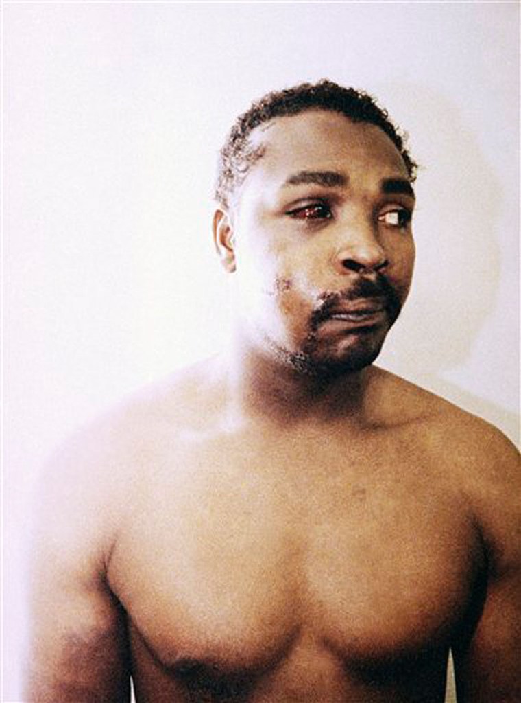 This file photo of Rodney King was taken three days after his videotaped beating in Los Angeles on March 6, 1991. King, the black motorist whose 1991 videotaped beating by Los Angeles police officers was the touchstone for one of the most destructive race riots in the nation's history, has died, his publicist said Sunday, June 17, 2012. He was 47. (AP Photo/Pool, File)
