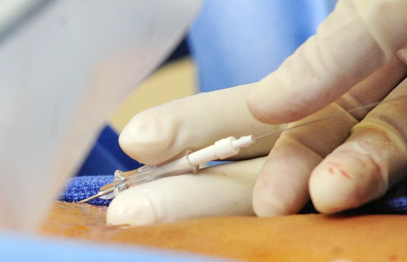 Dr. Chris Alvarado and nurse Kim Gallant thread a wire into a vein as they set up to perform a Venefit procedure to treat Vickie Hunnewell for chronic venous insufficiency recently in Manchester.