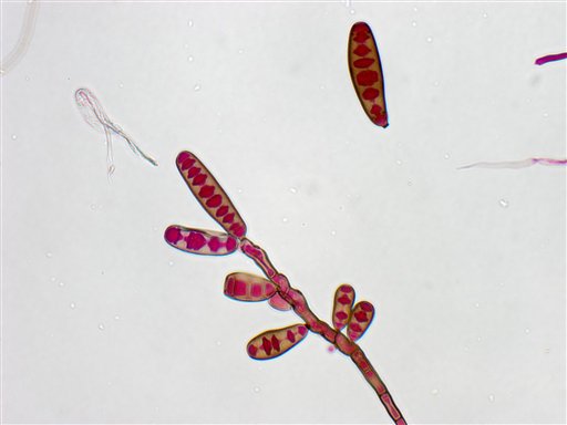 This undated file image from The Centers for Disease Control and Prevention shows the Exserohilum rostratum fungus. The black mold creeping into the spines of hundreds of people who got tainted shots for back pain marks uncharted medical territory. Autopsy findings make clear that treating early is crucial, before the fungus becomes entrenched.