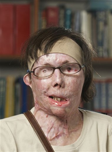 This July 2011 photograph provided by Brigham and Women's Hospital shows face transplant patient Carmen Blandin Tarleton before her surgery earlier this month.
