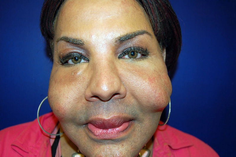 This is a Sept. 12, 2006 photograph provided by Dr. John J. Martin Jr., who specializes in eyelid and facial plastic surgery in Coral Gables, Fla., showing the damage illicit cosmetic procedures can cause recipients such as Rajindra Narinesinch, a patient whose face shows nodules from previous illicit procedures. (AP Photo/Dr. John J. Martin Jr., HO)
