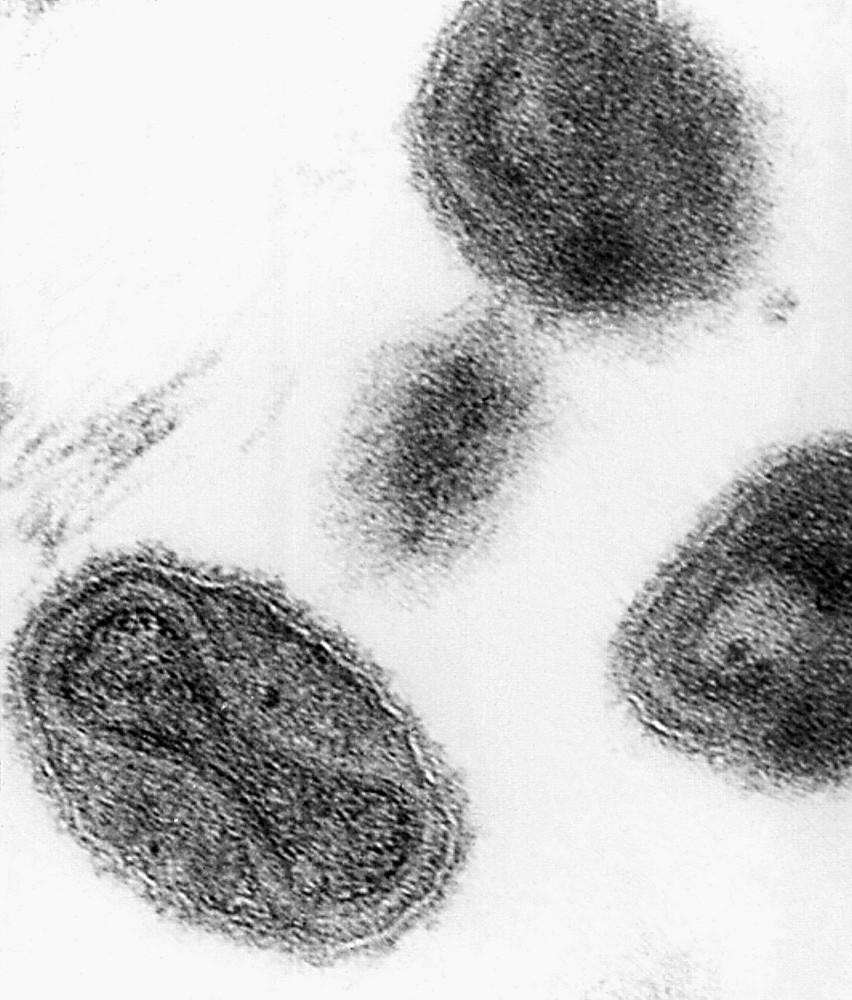 This 1975 file electronmicrograph from the Centers for Disease Control shows the smallpox virus. The last known case of smallpox was in Britain in 1978, when a university photographer who worked above a lab handling smallpox died after being accidentally exposed to it from the ventilation system.