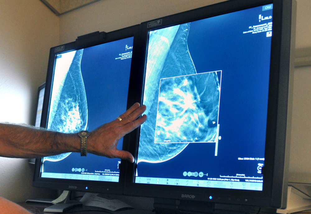 A radiologist compares mammogram images in Wichita Falls, Texas. New technology can detect much smaller cancers earlier.