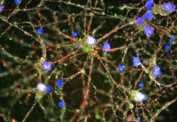 This image made with a fluorescent microscope shows C4 proteins (green), located at the synapses in a culture of human neurons. Scientists pursuing the biological roots of schizophrenia have zeroed in on a potential factor – a normal brain process that gets kicked into overdrive. The finding could someday lead to ways to treat the disease or even prevent it. Heather de Rivera/McCarroll Lab/Harvard via AP