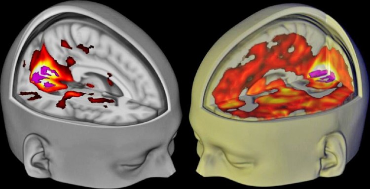 The brains of subjects lying awake with their eyes closed, under a placebo, left, and the drug LSD, right, are seen when being examined using functional MRI. Image provided by Imperial College London and The Beckley Foundation