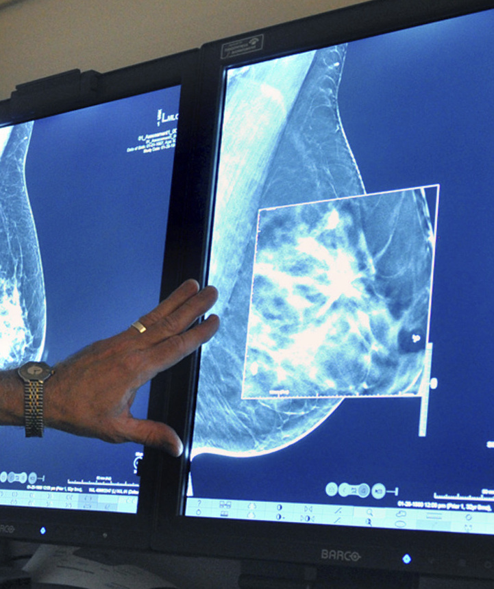 Mammograms can lead to overdiagnosis and overtreatment, a new study finds.