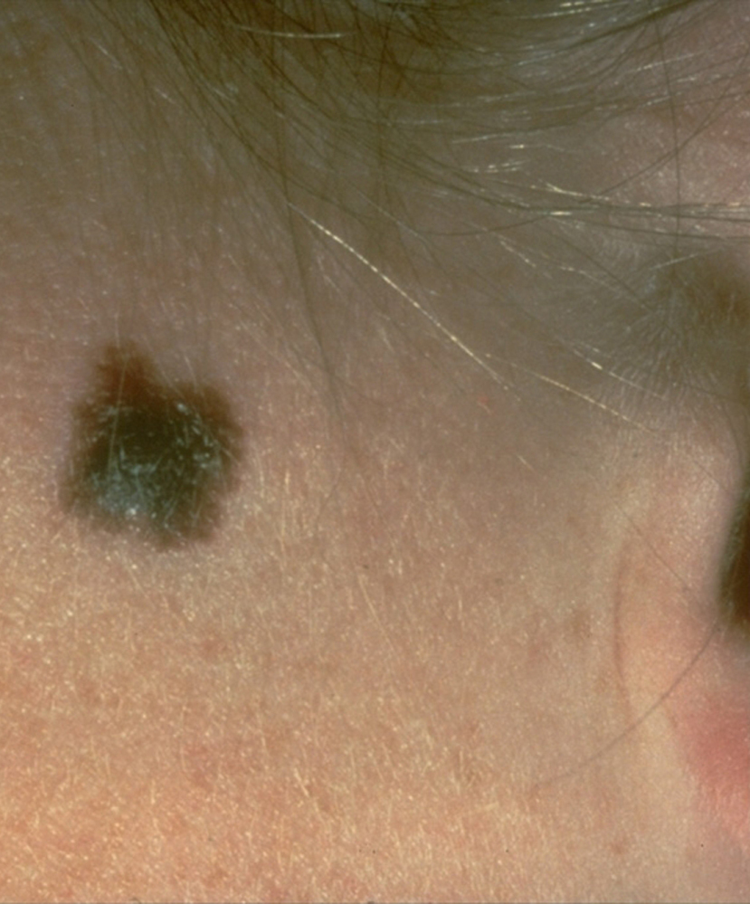 FILE - This photo provided by the American Academy of Dermatology shows a typical presentation of a suspicious mole that eventually was diagnosed as melanoma. A study released Wednesday, Dec. 28, 2016, suggests a decline in melanoma cases and deaths in Northeast states buck a national trend for the deadliest skin cancer and may reflect the benefits of strong prevention programs. (American Academy of Dermatology via AP)