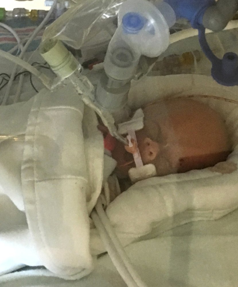 Life Lynn DeKlyen lies in the neonatal intensive care unit of the University of Michigan Hospital in Ann Arbor, Mich., on Saturday. 

Nick DeKlyen/Courtesy of Sonya Nelson via AP
