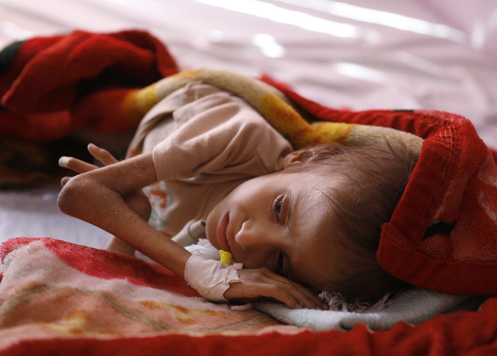 A malnourished child lies in a hospital in Sanaa, Yemen. Save the Children says 130 children die every day in Yemen from hunger and disease.