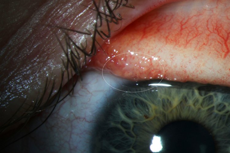 This August 2016 photo provided by Oregon Health & Science University (OHSU) shows inflammation (in the circle added by the source) from the infection caused by Thelazia gulosa. The Oregon woman who had worms coming out of her eye is being called the first known human case of a parasitic infection spread by flies. 