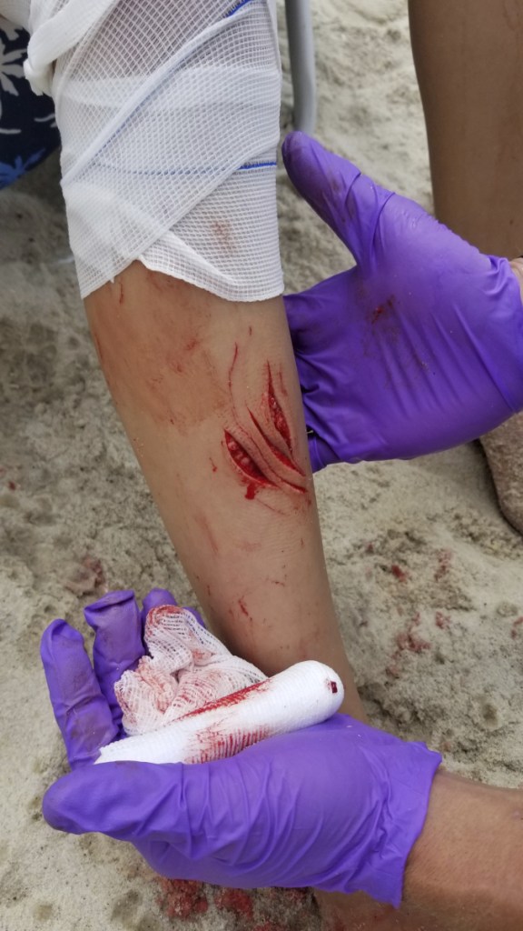 A first responder treats wounds consistent with a shark attack on the leg of Pollina's 12-year-old daughter on Sailors Haven beach at the Fire Island National Seashore on Wednesday.