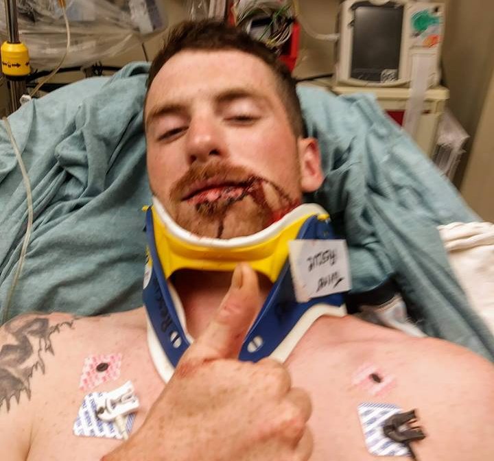 Cameron Hart is shown in his hospital bed after being hit in the face by a ricocheting bullet while he was playing disc golf in Turner.
