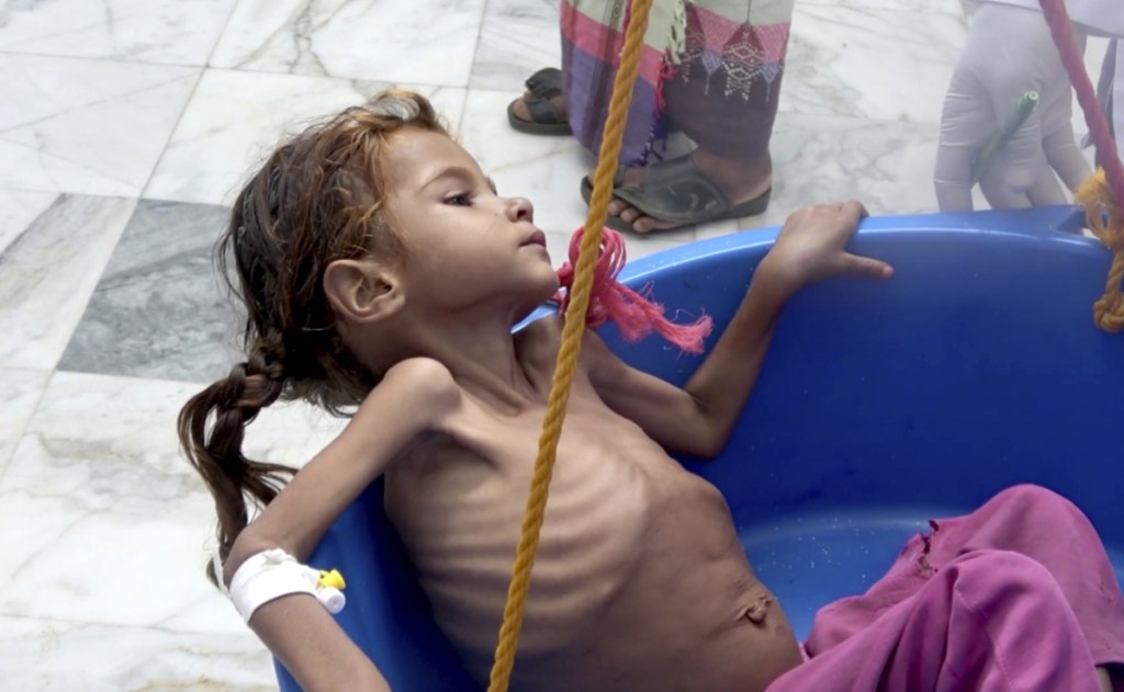 A severely malnourished girl is weighed at the Aslam Health Center in Hajjah, Yemen, in August. About 2.9 million women and children are in danger of starving to death.