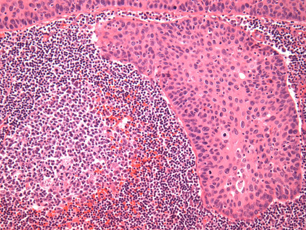This undated microscope image provided by the NewYork-Presbyterian/Columbia University Irving Medical Center in October 2018 shows squamous cell carcinoma of the cervix, the most common form of cervical cancer. 