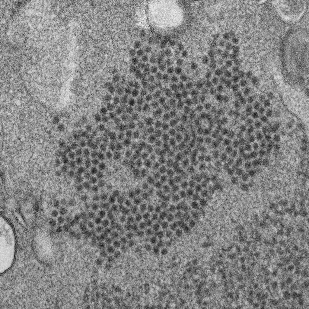 Doctors suspect a mysterious paralyzing illness, acute flaccid myelitis, might be tied to the Enterovirus-D68 (EV-D68) virus. This year has seen a record number of cases of the mysterious paralyzing illness in children, U.S. health officials said Monday.